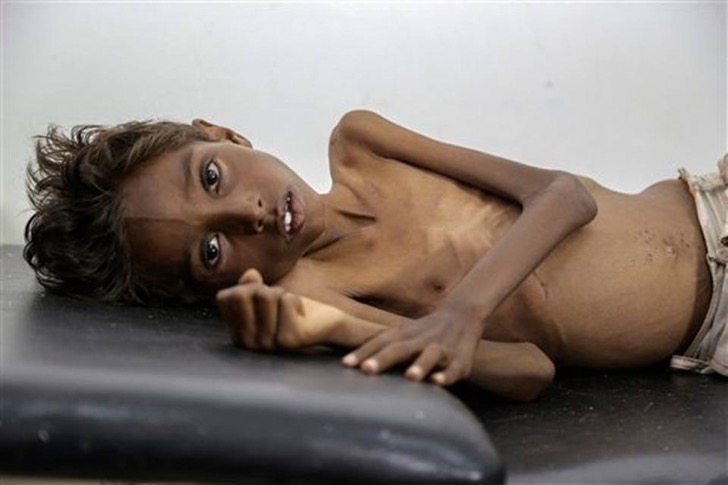 ONU alerta sobre las muertes que causara la hambruna en Yemen