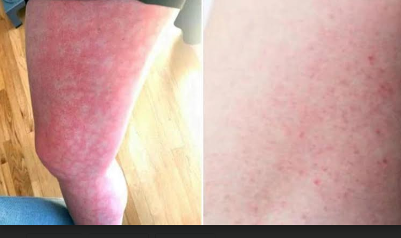 Marcas en la piel, otro síntoma que estaría generando el Coronavirus 