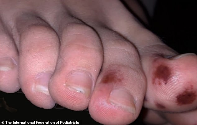 Descubren extrañas marcas en los pies de niños infectados con COVID 19 